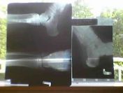 Skup klisz zdięc RTG rentgenowskich tel.506348194